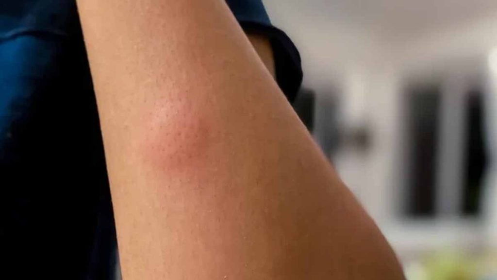 Epitheloides Angiosarkom